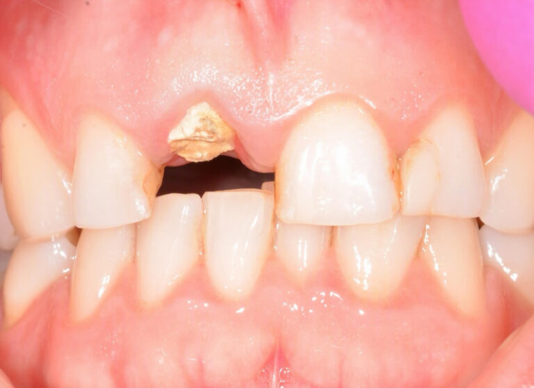 Implantacja natychmiastowa - przed