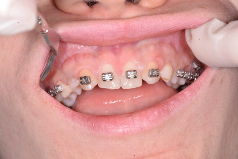Implantacja, ortodoncja, flow - przed