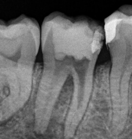 Pacjentka zgłosiła się na wizytę skierowana przez lekarza prowadzącego z powodu fragmentacji części narzędzia endodontycznego w czasie leczenia kanałowego. - po