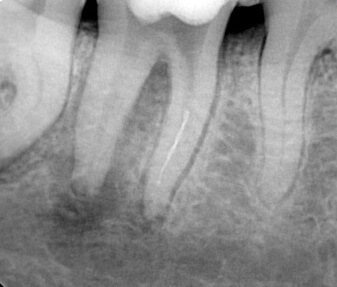 Pacjentka zgłosiła się na wizytę skierowana przez lekarza prowadzącego z powodu fragmentacji części narzędzia endodontycznego w czasie leczenia kanałowego. - przed